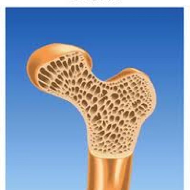 Osteoporosi: Prevenzione e Cura