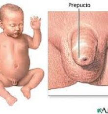 Fimosi