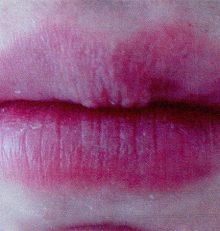 Filler labbra… non solo volume!