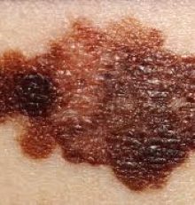 Che cos’è il melanoma