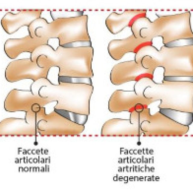 La sindrome delle faccette articolari