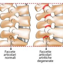 La sindrome delle faccette articolari