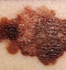 Che cos’è il melanoma