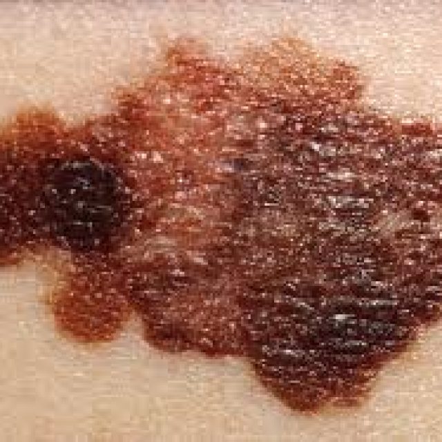Che cos’è il melanoma