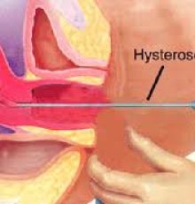 ISTEROSCOPIA DIAGNOSTICA: CONCETTI DI BASE