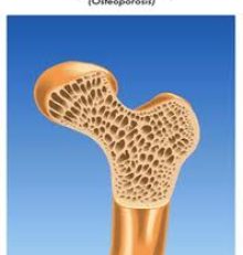 Osteoporosi: Prevenzione e Cura
