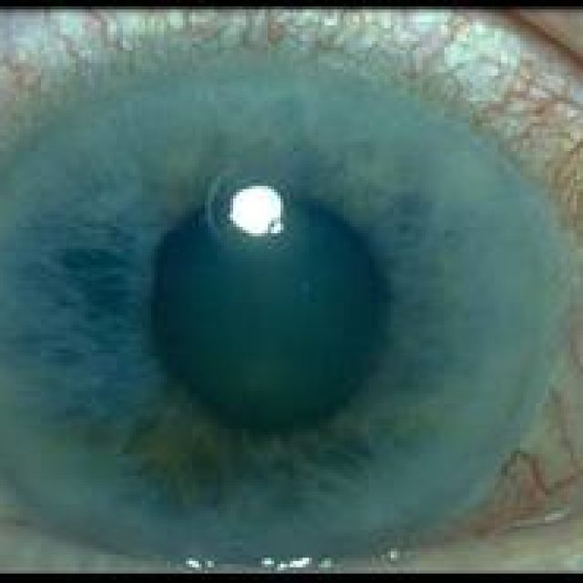 Glaucoma