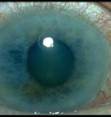 Glaucoma