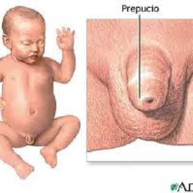 Fimosi