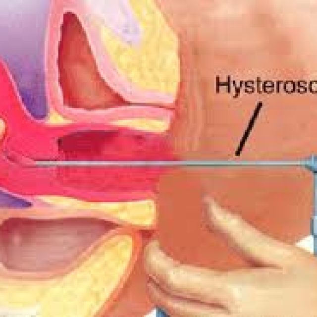 ISTEROSCOPIA DIAGNOSTICA: CONCETTI DI BASE