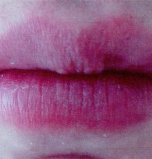 Filler labbra… non solo volume!